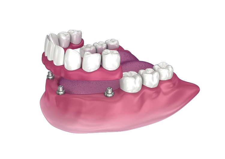 vse na štiri zobne proteze-zobni vsadki center dr goran slivar Hrvaška-image002