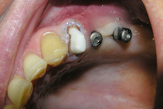 Zobni karies in izguba zob