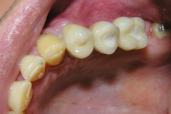 polnjenje koreninskih kanalov in ohranitev zob s kompozitno plombo ter nadomeščanje ekstrahiranih zob z vsadki v zgornji čeljusti