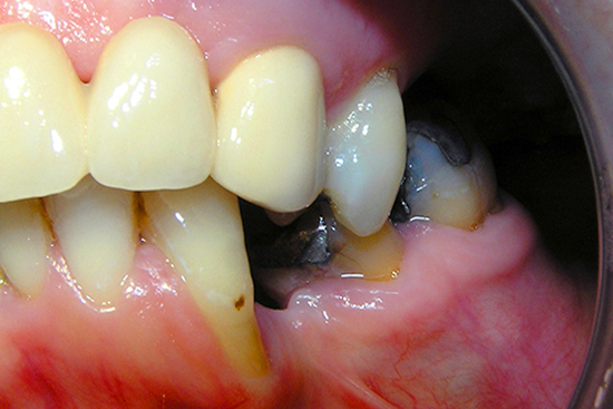 Zobni karies in izguba zob